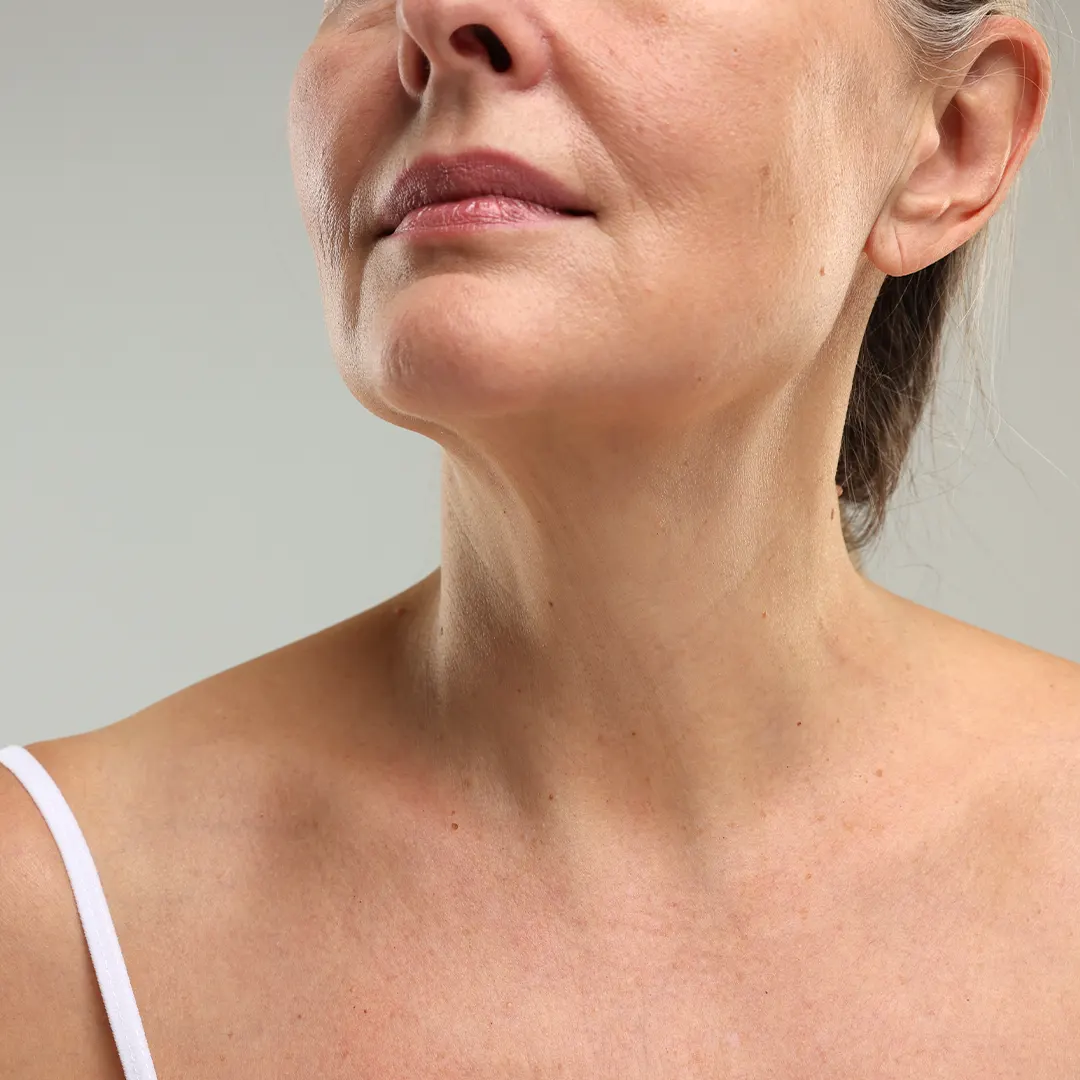 mandíbula de mujer luego de tratamiento con hilos de sustentación facial